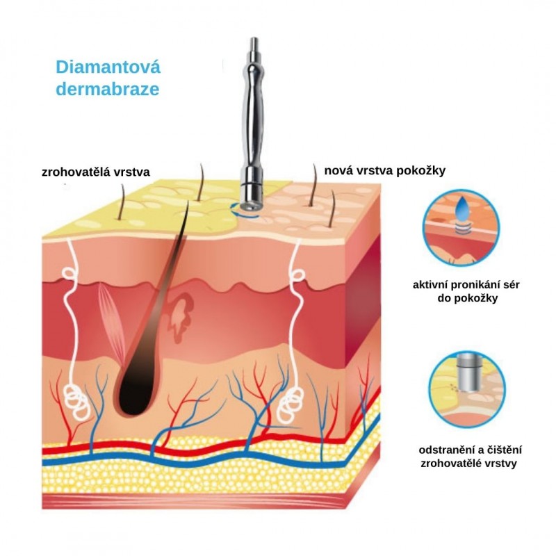 Diamantová mikrodermabraze