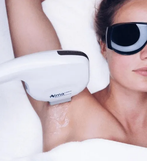 Laserová IPL epilace